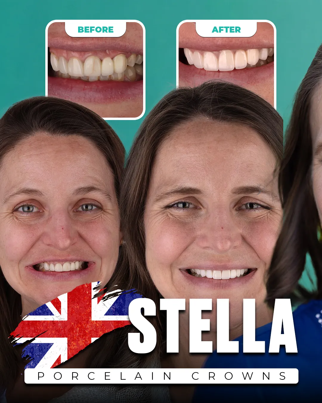 Before and after: Porcelain Crowns for Stella from United Kingdom