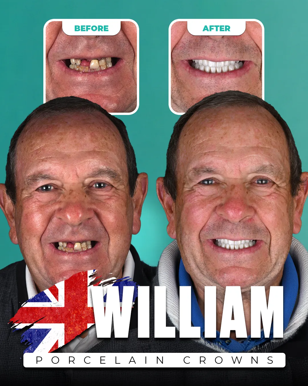 Before and after: Porcelain Crowns for William from United Kingdom