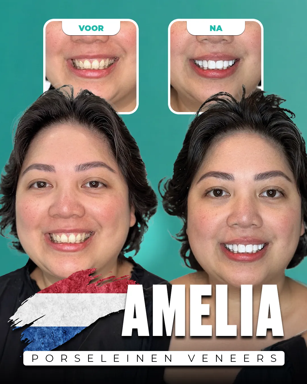 Before and after: Porcelain Veneers for Amelia from Netherlands