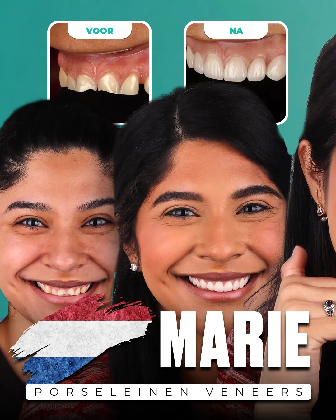 Before and after: Porcelain Veneers for Marie from Netherlands