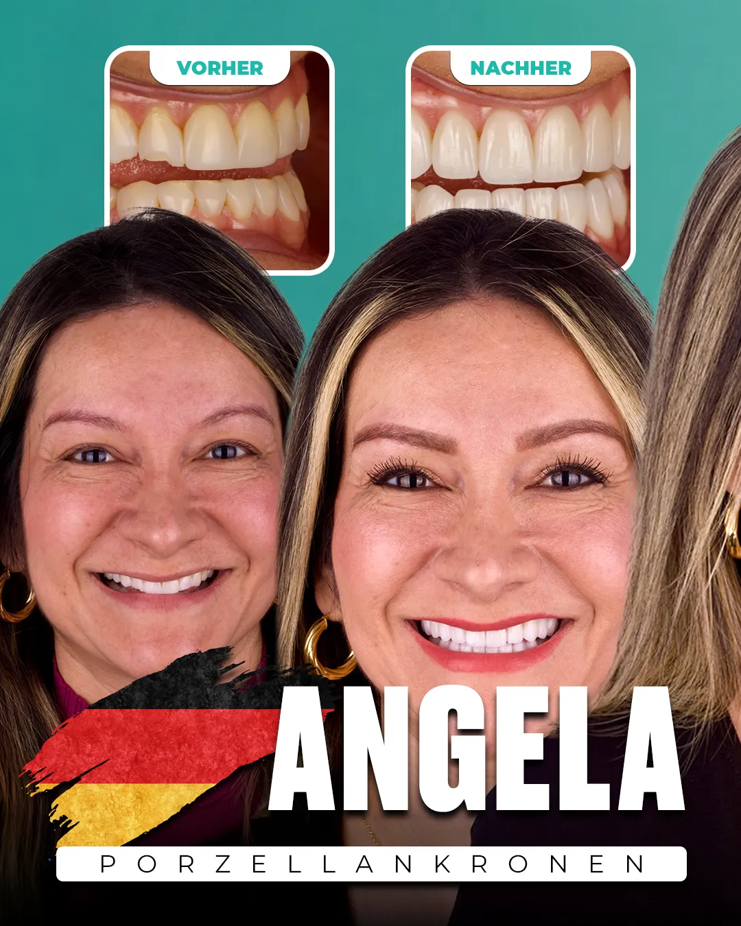 Before and after: Porcelain Crowns for Angela from Germany