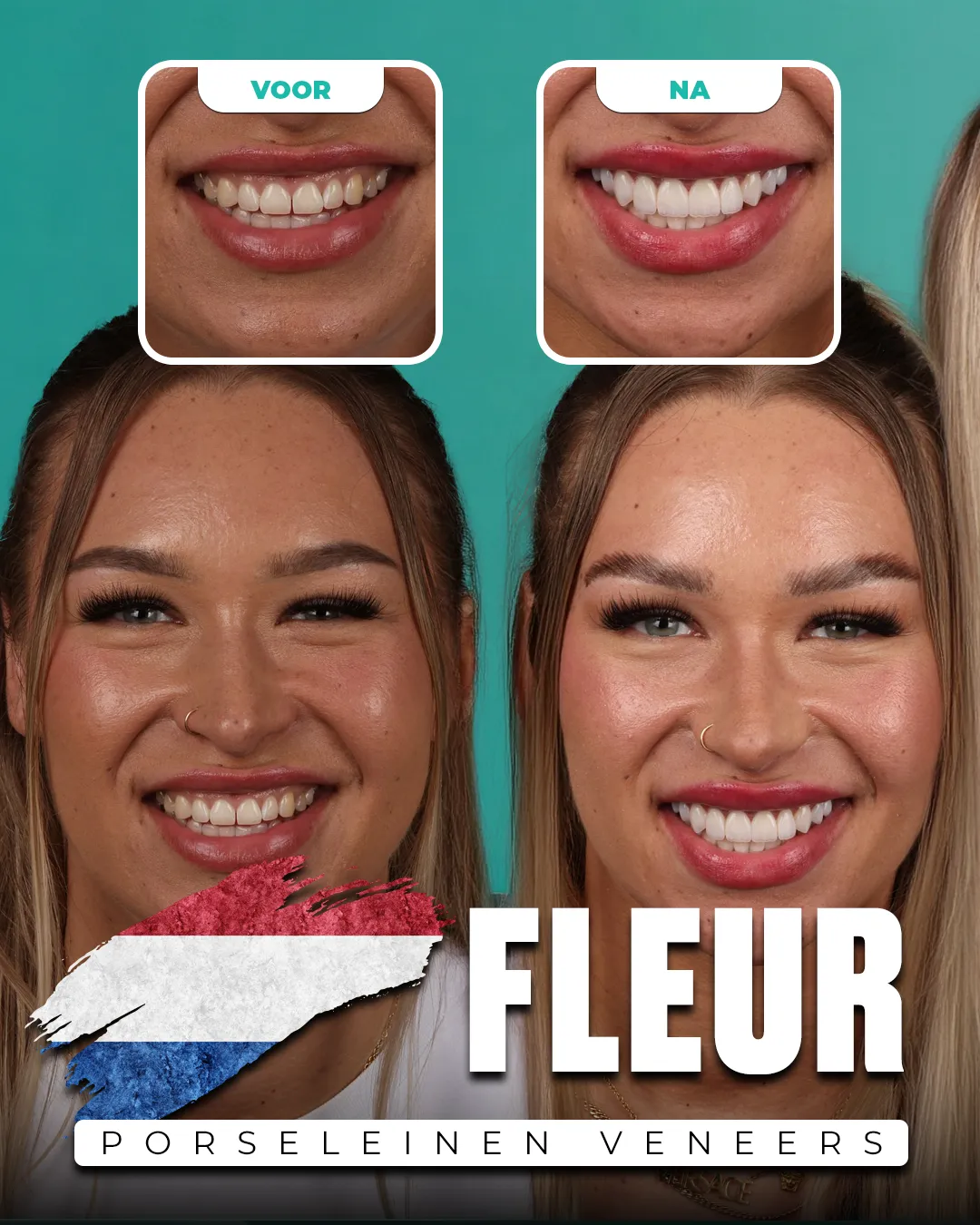 Before and after: Porcelain Veneers for Fleur from Netherlands