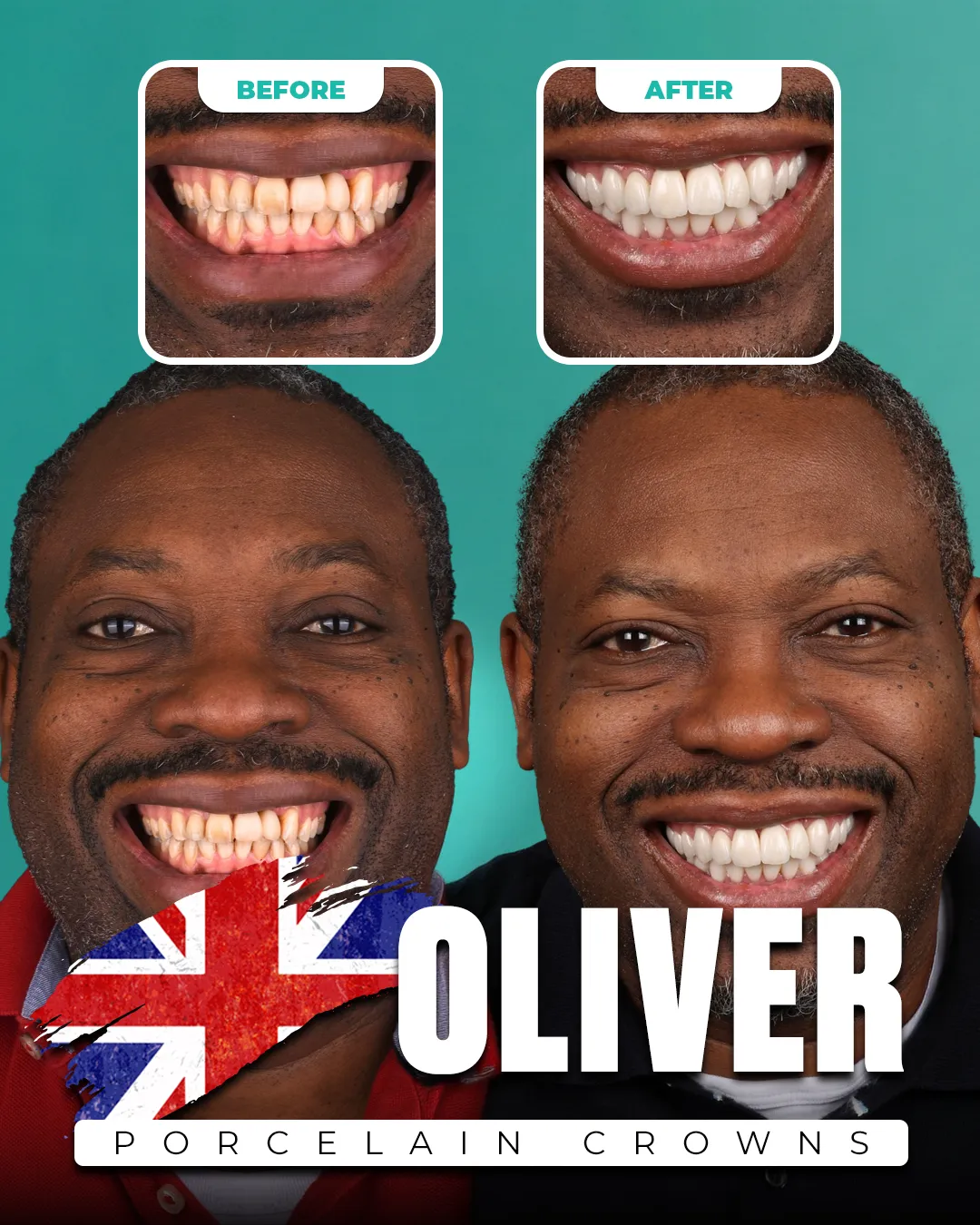 Before and after: Porcelain Crowns for Oliver from United Kingdom