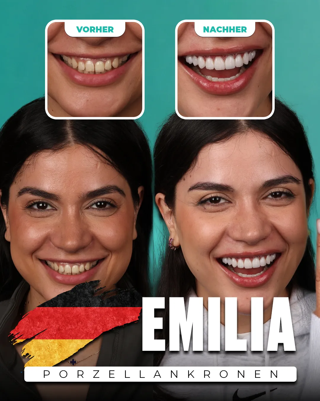 Before and after: Porcelain Crowns for Emilia from Germany