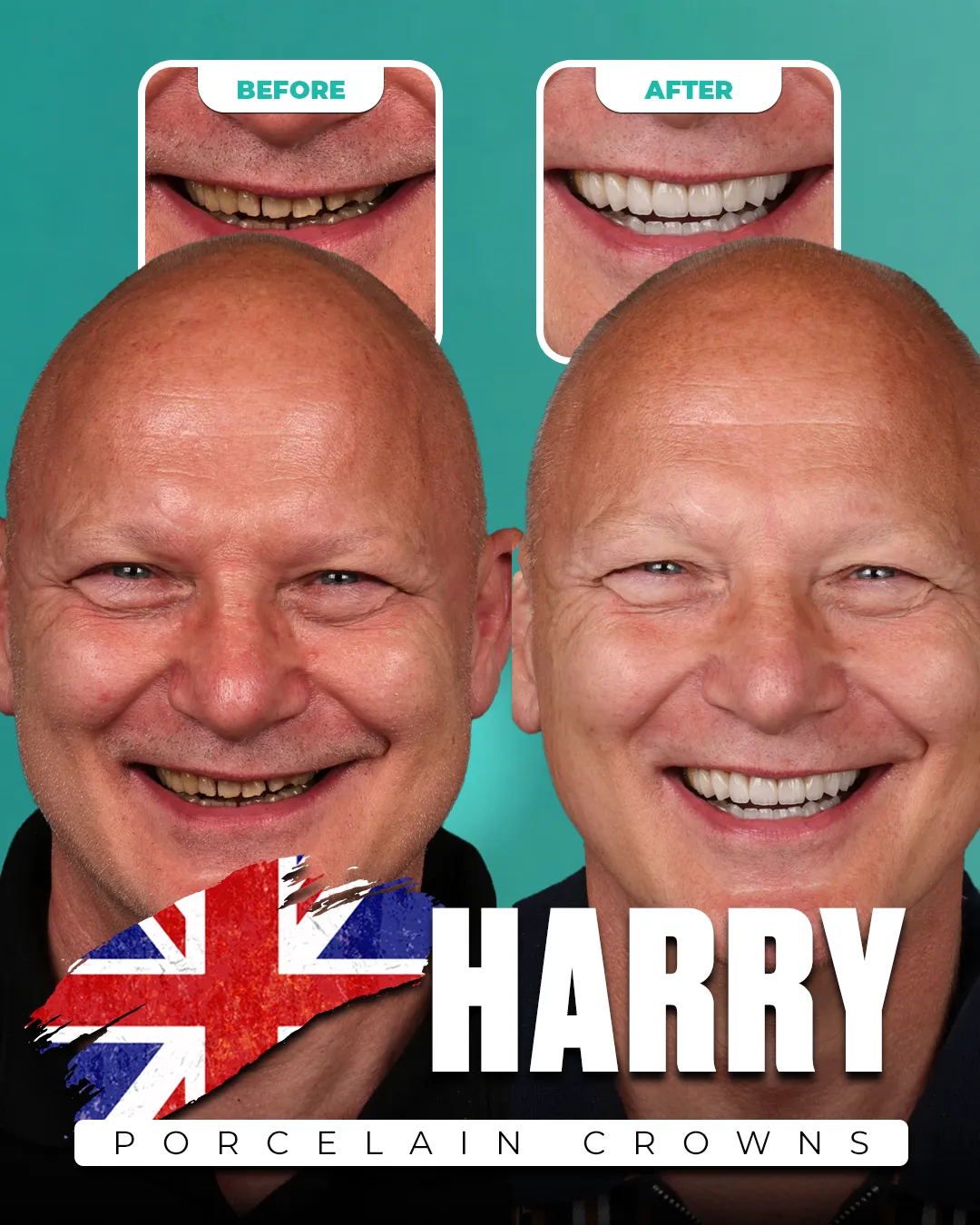 Before and after: Porcelain Crowns for Harry from United Kingdom