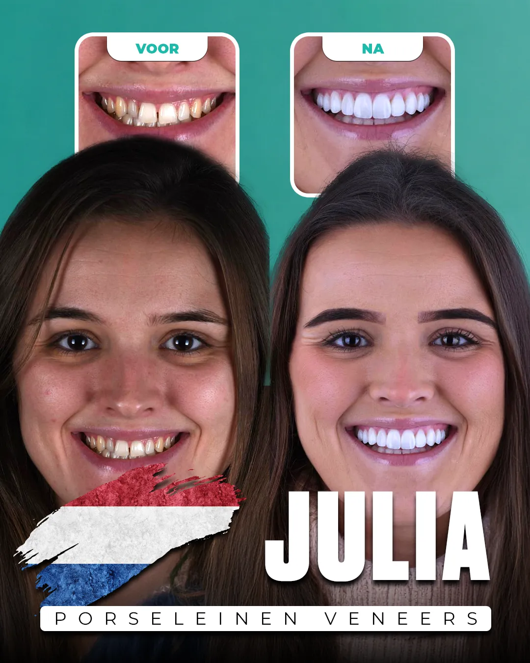 Before and after: Porcelain Veneers for Julia from Netherlands