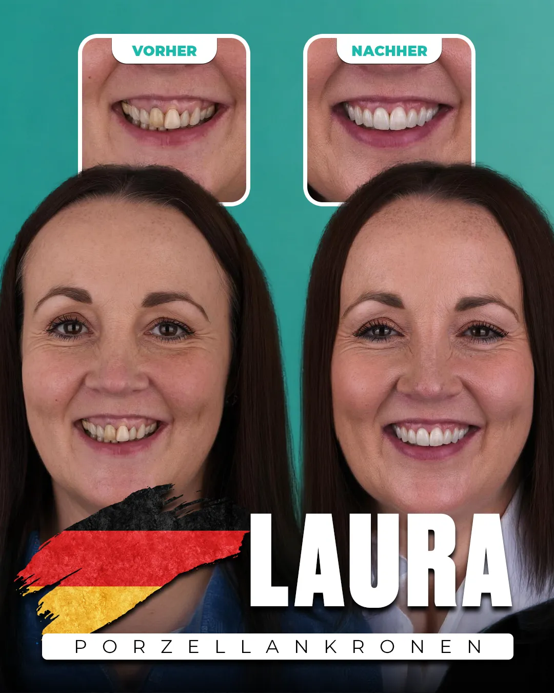 Before and after: Porcelain Crowns for Laura from Germany